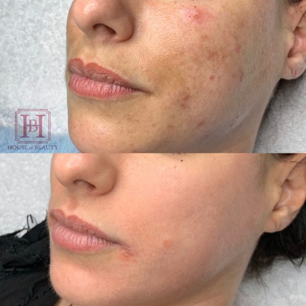 photo femme avant/après traitement dépigmentation faciale