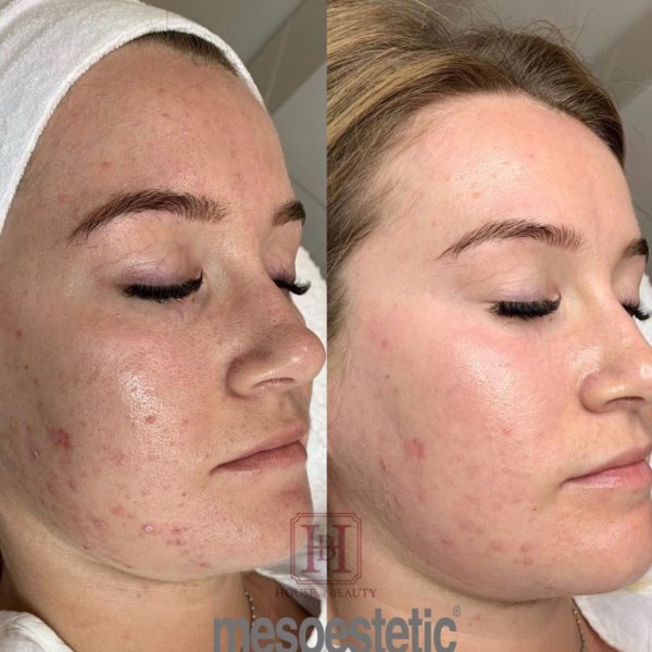 femme avant/après traitement pour l'acné