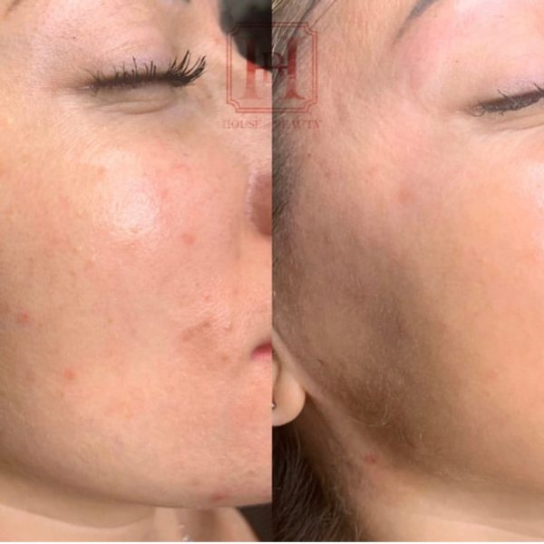 femme avant/après traitement pour l'acné